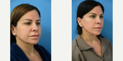 Neck Lift before and after photo
