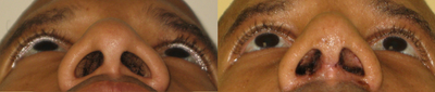Rhinoplasty before and after photo