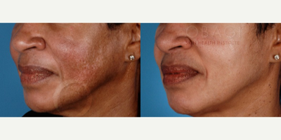 Skin Rejuvenation before and after photo