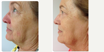 Skin Rejuvenation before and after photo