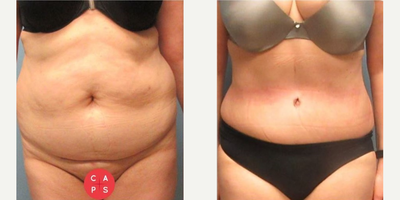 Tummy Tuck before and after photo