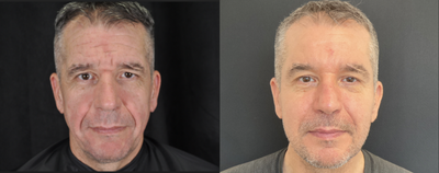 Dermal Fillers before and after photo