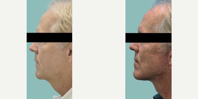 Facelift before and after photo