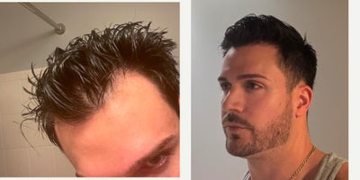 Hair Transplant before and after photo