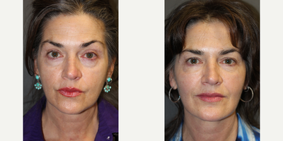 Juvederm before and after photo