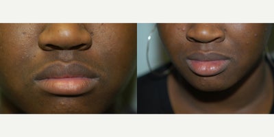 Lip Fillers before and after photo