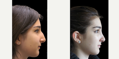 Rhinoplasty before and after photo