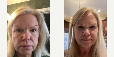 Bellafill before and after photo