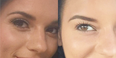 Botox before and after photo