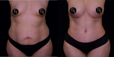 Breast Augmentation before and after photo