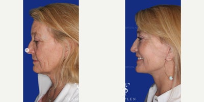 Brow Lift before and after photo