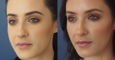 Dermal Fillers before and after photo