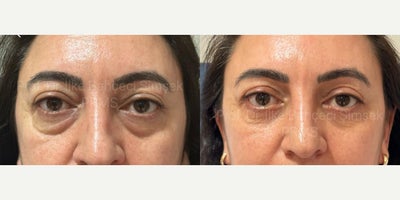 Double Eyelid Surgery before and after photo