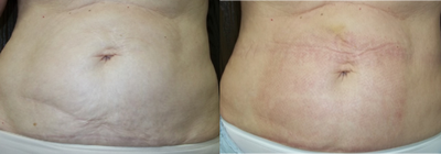 Fractora RF before and after photo