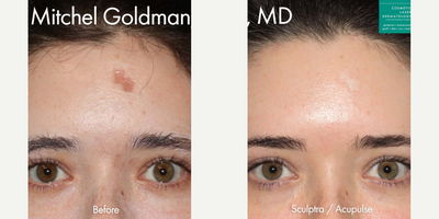 Laser Resurfacing before and after photo
