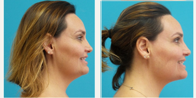 Liposuction before and after photo