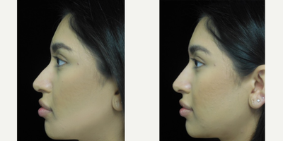 Nonsurgical Nose Job before and after photo