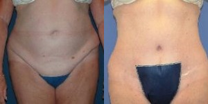 Tummy Tuck before and after photo