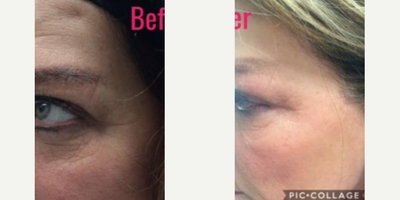 Botox before and after photo