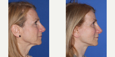 Cheek Lift before and after photo