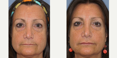 Restylane before and after photo