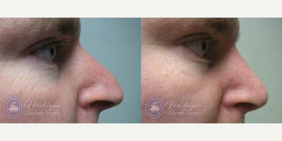 Rhinoplasty before and after photo