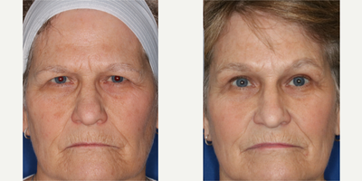 Brow Lift before and after photo