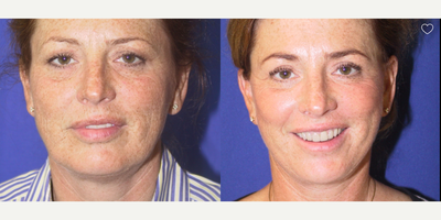 Deep Plane Facelift before and after photo