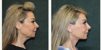 Deep Plane Facelift before and after photo