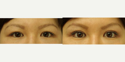 Double Eyelid Surgery before and after photo