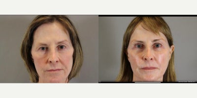 Facial Fat Transfer before and after photo