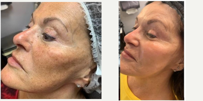 IPL before and after photo