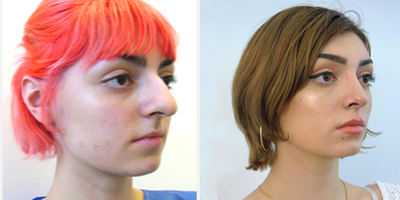 Rhinoplasty before and after photo