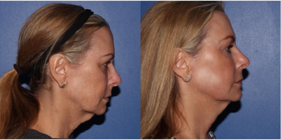 Scar Removal before and after photo
