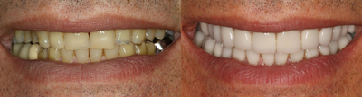 Smile Makeover before and after photo