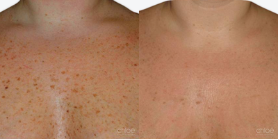 Chemical Peel before and after photo