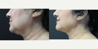 CoolSculpting before and after photo