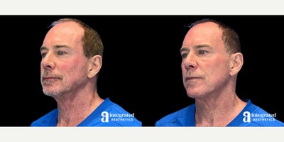 Dysport before and after photo