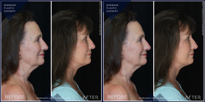 Facelift before and after photo