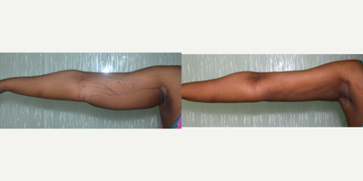 Liposuction before and after photo