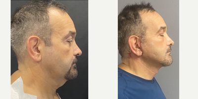 Neck Lift before and after photo