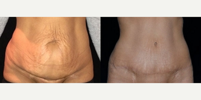 Tummy Tuck before and after photo