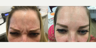 Botox before and after photo