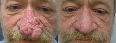 Dermabrasion before and after photo