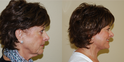 Facelift before and after photo
