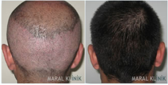 FUE Hair Transplant before and after photo