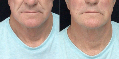 Radiesse before and after photo