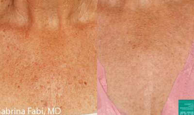 IPL before and after photo