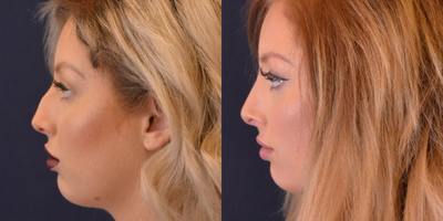 Rhinoplasty before and after photo