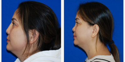 Rhinoplasty before and after photo
